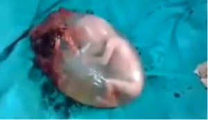 amniotic2