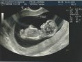 Увидеть ультразвуковое изображение внутриутробного ребенка – предотвратить аборт