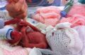 Жизнь этого недоношенного ребенка была спасена благодаря ножницам