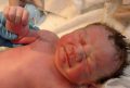 Малыш родился  с противозачаточным имплантантом в руке