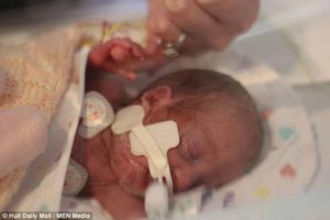 Девочка родилась через две недели после брата-близнеца и выжила