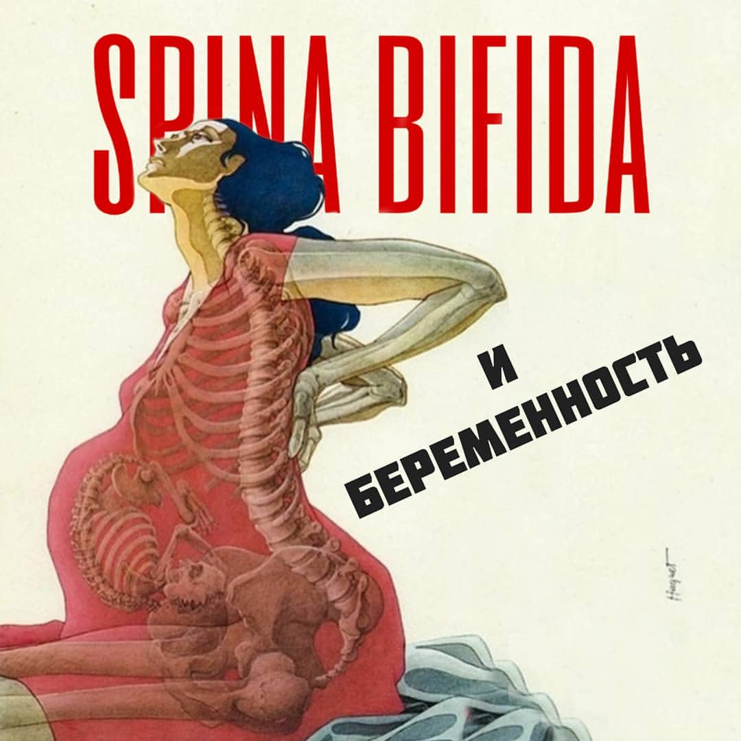 Может ли женщина со спина бифида выносить ребёнка